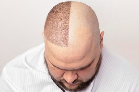 ¿Qué es la micropigmentación capilar?