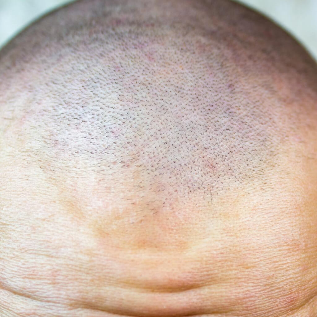 ¿Qué es la micropigmentación capilar?